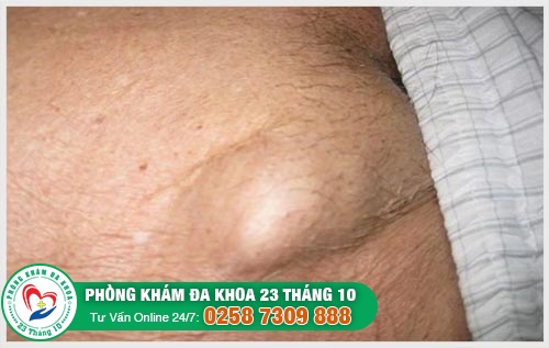 Nguyên nhân gây nổi hạch ở dương vật là gì?
