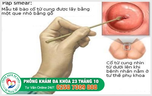Xét nghiệm Pap Smear để phát hiện ra bệnh sùi mào gà